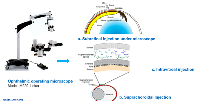 ÌØÊâµÄÑÛ²¿ÇòÄÚ¸øÒ©¼¼Êõ