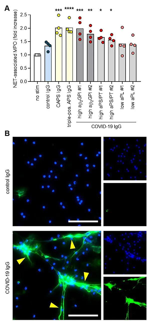 COVID-19����IgG������������������������ϸ���ͷ�NET