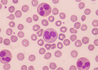 һ�����ؿ����������ˣ����ܷ��Ϊ��Ѫ֢��ɸ�����������������