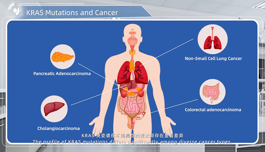 KRAS ͻ���방֢�Ĺ�ϵ